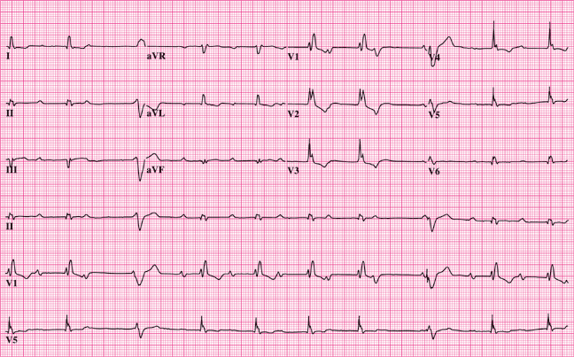 electrocardiograma_trazado
